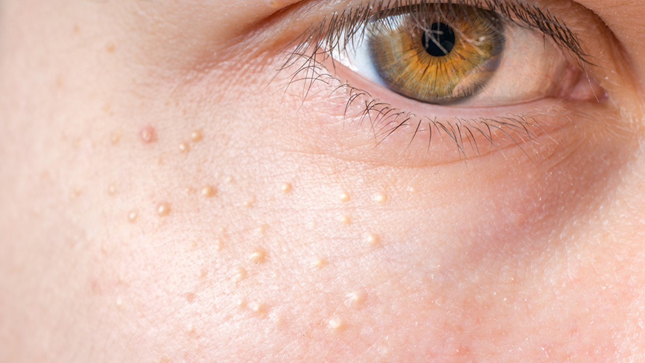 Milia Removal: Safe & Effective Treatments for Clear Skin 1 What Are Milia?